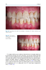 Esthetic Oral Rehabilitation with Veneers A Guide to Treatment Preparation 2020 - Image 5