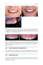Esthetic Oral Rehabilitation with Veneers A Guide to Treatment Preparation 2020 - Image 7