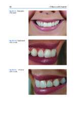 Esthetic Oral Rehabilitation with Veneers A Guide to Treatment Preparation 2020 - Image 10