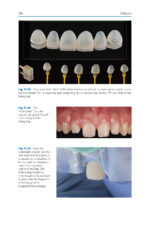 Esthetic Oral Rehabilitation with Veneers A Guide to Treatment Preparation 2020 - Image 11