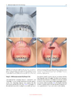 Minimally Invasive (MI) Orthognathic Surgery 2023 - Image 2