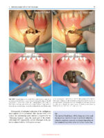 Minimally Invasive (MI) Orthognathic Surgery 2023 - Image 4