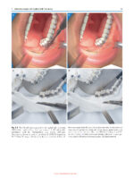 Minimally Invasive (MI) Orthognathic Surgery 2023 - Image 5