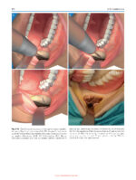 Minimally Invasive (MI) Orthognathic Surgery 2023 - Image 6