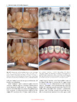 Minimally Invasive (MI) Orthognathic Surgery 2023 - Image 7