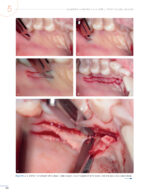 Periodontal and Peri-implant Plastic Microsurgery 2021 - Image 8