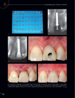 Periodontal and Peri-implant Plastic Microsurgery 2021 - Image 4