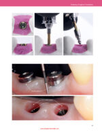 Implant Prosthodontics Protocols and Techniques for Fixed Implant Restorations 2022 - Image 6