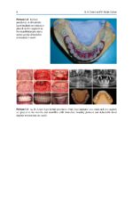 Treatment Options Before and After Edentulism 2024 - Image 2