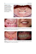 Treatment Options Before and After Edentulism 2024 - Image 6