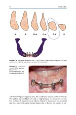 Treatment Options Before and After Edentulism 2024 - Image 5