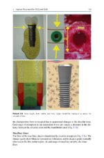 Treatment Options Before and After Edentulism 2024 - Image 4