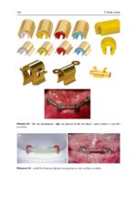 Treatment Options Before and After Edentulism 2024 - Image 3