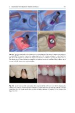 Treatment Planning in Implant Dentistry 2024 - Image 5
