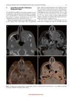 Atlas of Virtual Surgical Planning and 3D Printing for Cranio-Maxillo-Facial Surgery 2025 - Image 2
