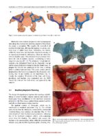 Atlas of Virtual Surgical Planning and 3D Printing for Cranio-Maxillo-Facial Surgery 2025 - Image 5
