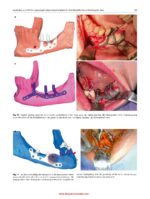 Atlas of Virtual Surgical Planning and 3D Printing for Cranio-Maxillo-Facial Surgery 2025 - Image 6
