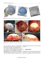 Atlas of Virtual Surgical Planning and 3D Printing for Cranio-Maxillo-Facial Surgery 2025 - Image 7