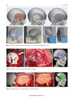 Atlas of Virtual Surgical Planning and 3D Printing for Cranio-Maxillo-Facial Surgery 2025 - Image 8