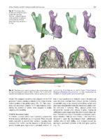 Atlas of Virtual Surgical Planning and 3D Printing for Cranio-Maxillo-Facial Surgery 2025 - Image 9