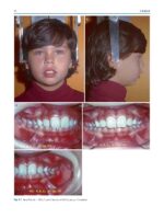 Clinical Cases in Early Orthodontic Treatment 2022 - Image 2