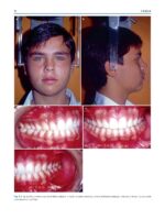 Clinical Cases in Early Orthodontic Treatment 2022 - Image 3