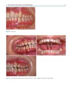 Clinical Cases in Early Orthodontic Treatment 2022 - Image 4