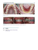 Clinical Cases in Early Orthodontic Treatment 2022 - Image 5