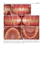 Clinical Cases in Early Orthodontic Treatment 2022 - Image 6