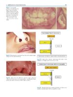 Clinical Cases in Early Orthodontic Treatment 2022 - Image 7