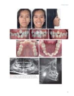 Passive Self Ligation from A to Z (Balut, 2022) - Image 7