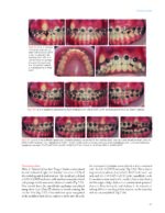 Passive Self Ligation from A to Z (Balut, 2022) - Image 6