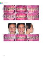 Passive Self Ligation from A to Z (Balut, 2022) - Image 4