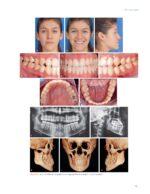 Passive Self Ligation from A to Z (Balut, 2022) - Image 3