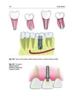 Peri-Implant Soft Tissue Management 2023 - Image 4