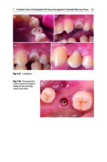 Peri-Implant Soft Tissue Management 2023 - Image 6