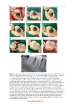 Vital Pulp Treatment  2024 - Image 10