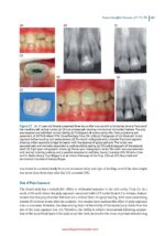 Vital Pulp Treatment  2024 - Image 4