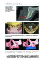 Zygomatic Implants Optimization & Innovation 2020 - Image 4