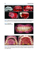 Zygomatic Implants Optimization & Innovation 2020 - Image 7