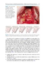 Zygomatic Implants Optimization & Innovation 2020 - Image 8
