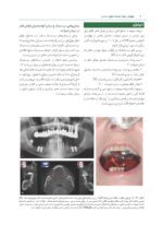 (عوارض درمان ایمپلنت های دندانی اتیولوژی، پیشگیری و درمان (فصول منتخب پروتز - Image 6